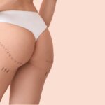 chirurgia plastica sedere – 1